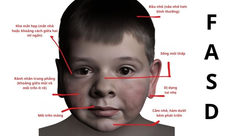 hội chứng fasd